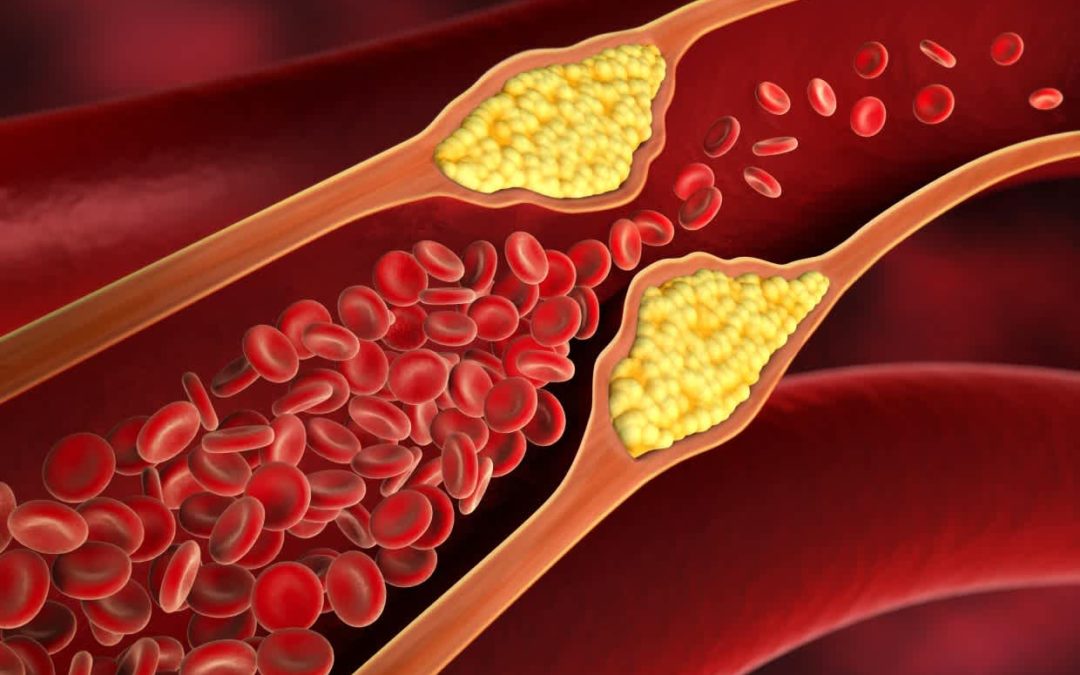 Cholesterol artery build up